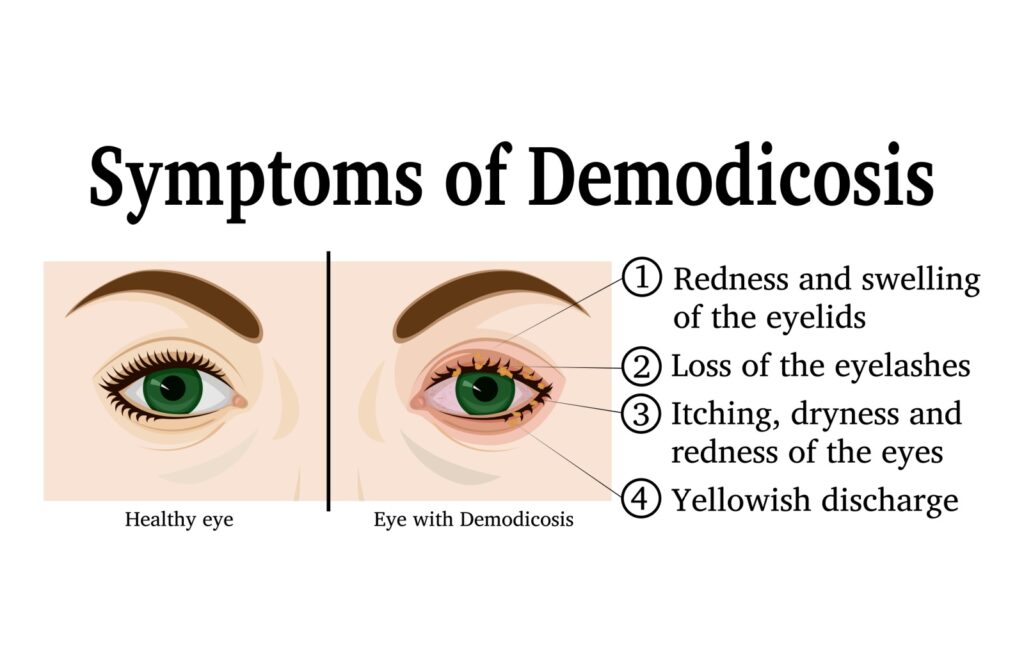 Symptoms of demodicosis.